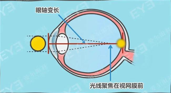 爱尔眼科警示：暑期高糖饮食成儿童近视 “隐形推手”科学防控刻不容缓(图1)